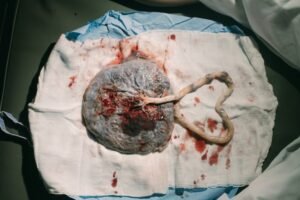 A delivered placenta and umbilical cord resting on a blue surgical drape, with the cord curled into a heart shape on the right side.